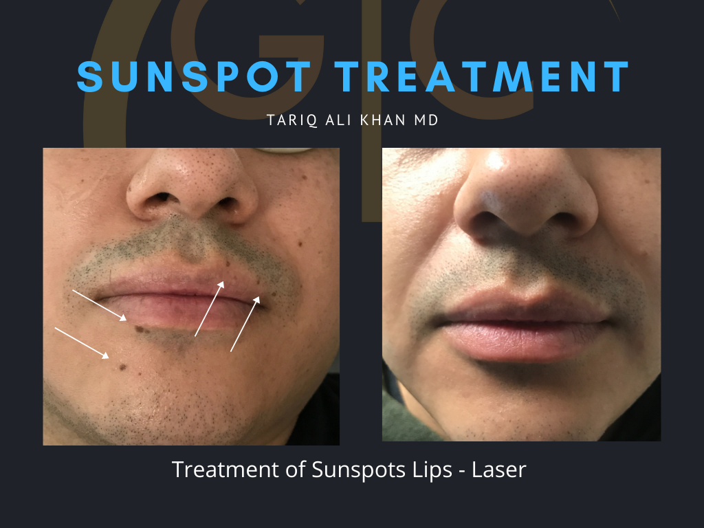 Gentle Care Laser Tustin & Long Beach Before and After picture - Sunspot treatment